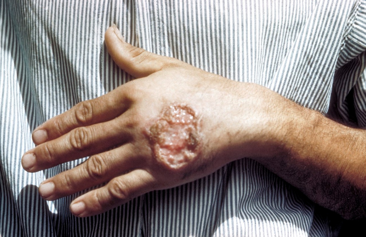 Mão de um homem com uma lesão de leishmaniose cutânea